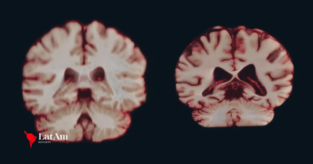 Cérebro de homens e mulheres envelhece em ritmos diferentes, revela estudo global