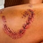 Turista mordida por tubarão em Fernando de Noronha diz que animal reagiu após ser atingido por guia