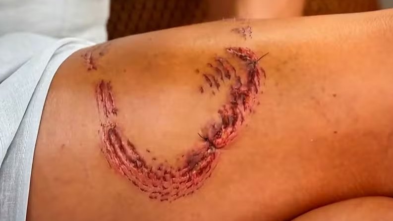 Turista mordida por tubarão em Fernando de Noronha diz que animal reagiu após ser atingido por guia